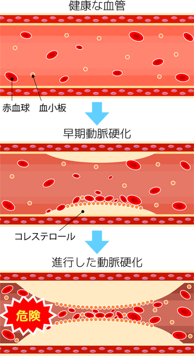 動脈硬化について